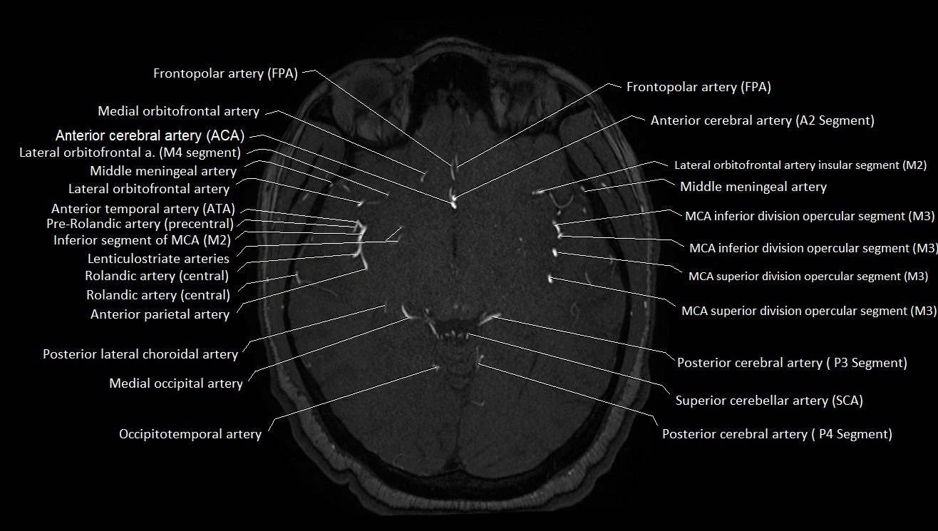 MRA brain (cerebral arteries) anatomy axial 3T image 22.webp